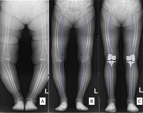 Lower Limb Long Film X Ray Severe Genu Varum In A Year Old Female