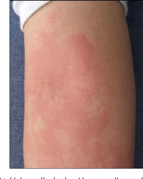 Figure 1 From Aquagenic Urticaria Diagnosed By The Water Provocation