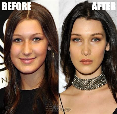 Bella Hadid Plastic Surgery Secrets Exposed