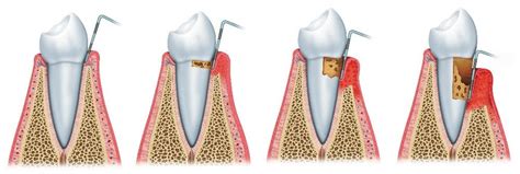 Treatment Of Tooth Mobility Smile Makeover Of La