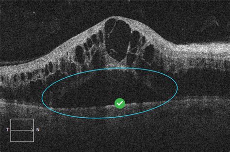 Subretinal Fluid - EyeCarePD