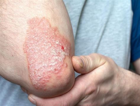 Comprendre le Psoriasis Une Affection Cutanée Qui Impacte des