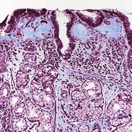 Microscopic Images Of The Mucosal Biopsy Specimen From The Stomach