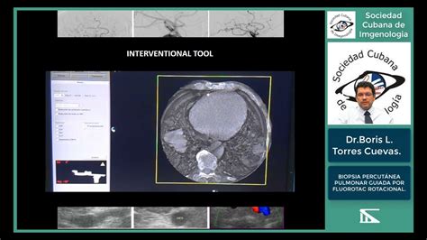 Biopsia percutánea pulmonar guiada fluoro TC rotacional Dr Boris Luis