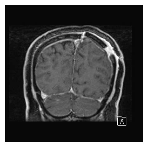 Gd Enhanced T Weighted Mri Postoperative Axial A Sagittal B