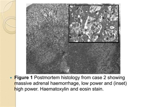 Waterhouse–friderichsen syndrome (wfs) | PPT