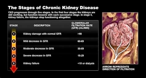 What Is Kidney Failure? - StoryMD