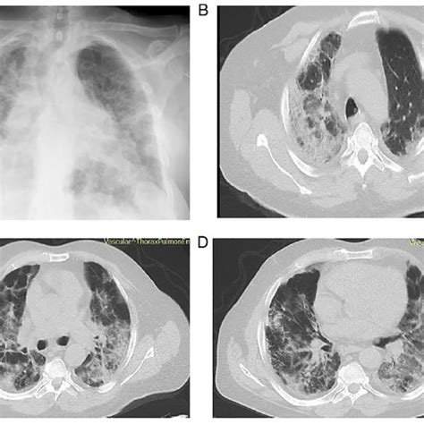 Chest X Ray And Computed Tomography Of The Patient In Case Performed