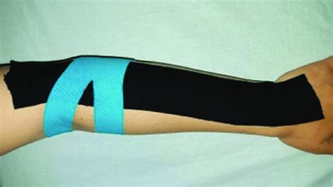 Kinesio Tape Lateral Epicondylitis