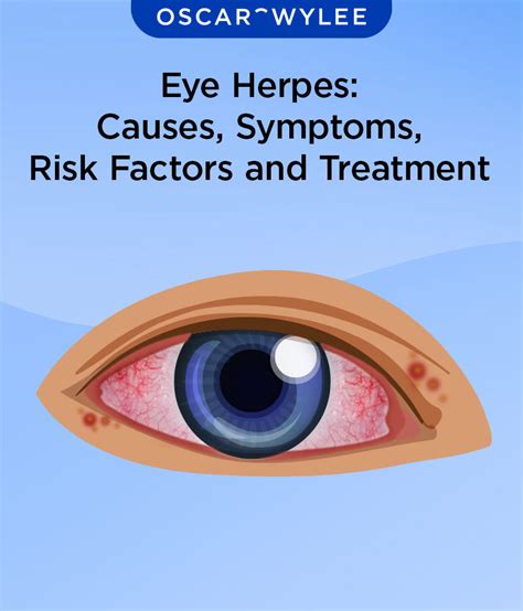 List 90 Pictures Herpes Of The Eyes Pictures Completed