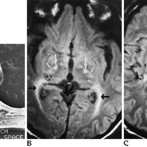 AMN with cerebral abnormalities limited to long tracts (type 1). A ...