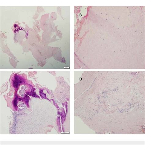 Pathology Specimen Of C7 T1 Resected Lesion A Hematoxylin And Eosin