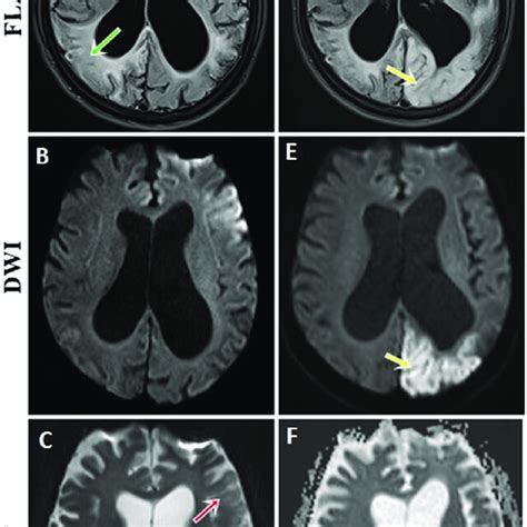 Mri Findings Fluid Attenuated Inversion Recovery Flair And Download Scientific Diagram