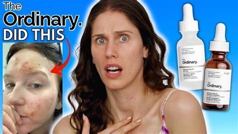 What Happened To The Ordinarys Salicylic Acid Vs The New Salicylic