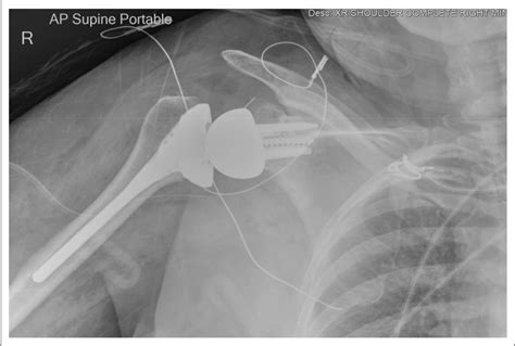 Figure 1 From Iatrogenic Injury To The Suprascapular Nerve Following