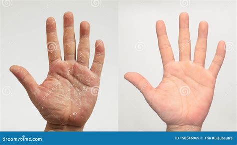 Treatment Psoriasis On Palms Of Hands