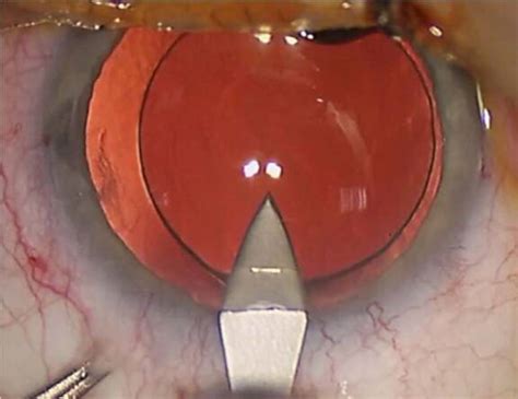 Techniques Dexplantation Des Implants Intraoculaires