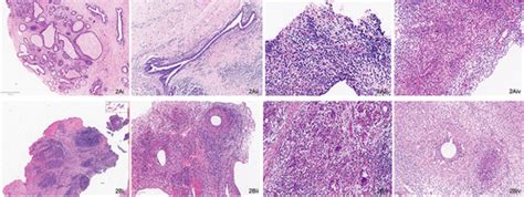 Full Article Periductal Mastitis A Disease With Distinct Clinicopathological Features From