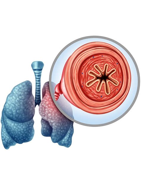 Systematic review updates evidence for inhaled corticosteroids in ...