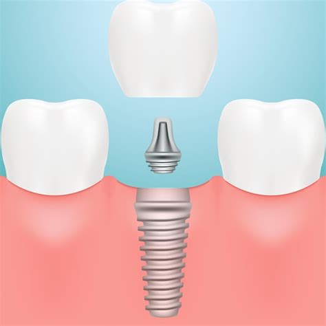 Premium Vector Human Teeth And Dental Implants Isolated On A