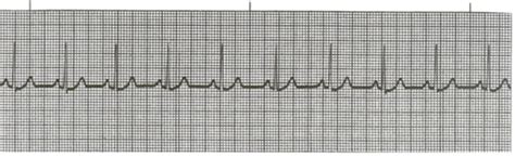 Ekg Exam Flashcards Quizlet