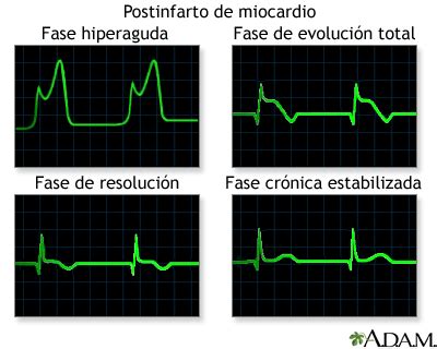 Gr Ficos De Las Ondas Del Ecg Despu S Del Infarto Al Miocardio