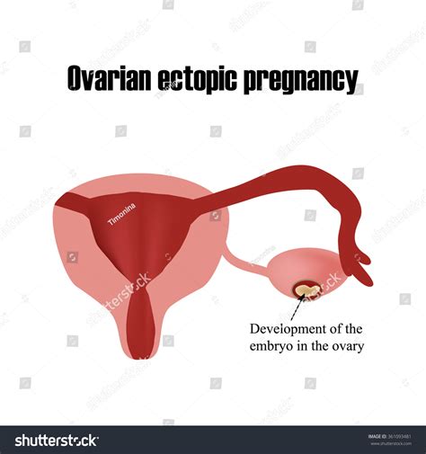 Development Embryo Ovary Ectopic Pregnancy Infographics Stock Vector