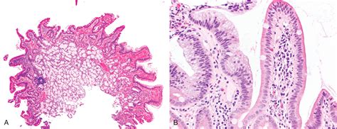 Polyps Of The Small Intestine Clinical Tree