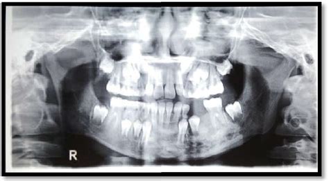 Figure 1 From Primary Tuberculous Osteomyelitis Of Pediatric Mandible Diagnostic Dilemma