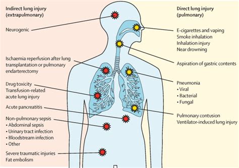 Acute respiratory distress syndrome: causes, pathophysiology, and ...