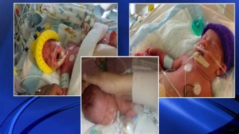 Rare Identical Triplets, Two Conjoined, Born in Texas