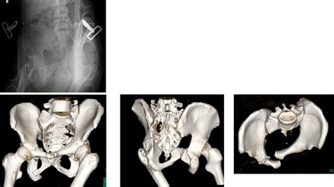 A Anteroposterior X Ray At The Emergency Room With A Pelvic Binder