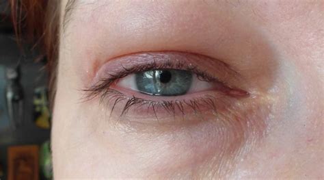 Yeux Gonfl S Astuces Naturelles Pour D Congestionner Les Paupi Res