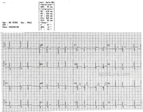 Premature Atrial Contraction Ecg Guru Instructor Resources