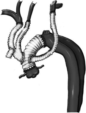 Hybrid Aortic Arch Debranching With Staged Endovascular Completion In