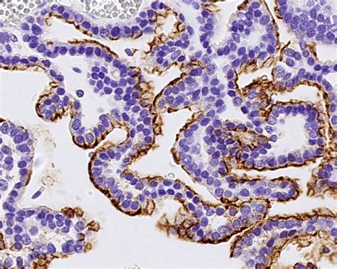 Pathology Outlines Choroid Plexus Tumors Papilloma Atypical