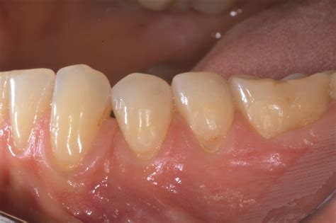 Gel Di Acido Ialuronico Reticolato Per La Chirurgia Dentale