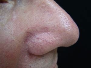 Spider Veins On Nose