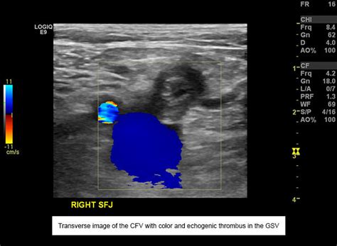 Lower Extremity Venous Duplex