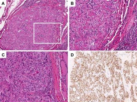 Pax Glis Gene Fusion Is A Pathognomonic Genetic Alteration Of