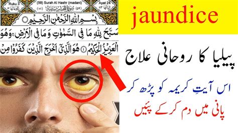 Jaundice Ka Ruhani Ilaj Piliya Ka Ilaj Msr Quadri YouTube