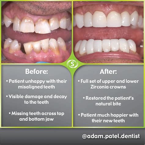 Zirconia Crowns • Synergy Dental Clinic