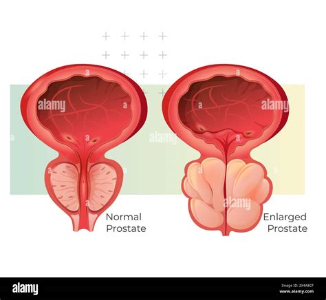 Normal Prostate And Enlarged Prostate Gland Under Bladder Stock Illustration As Eps 10 File