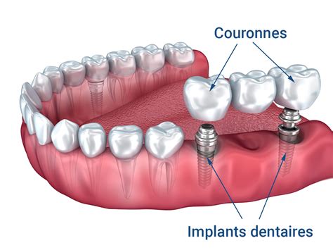 Bridge Dentaire De 3 Dents En Espagne Uedentaire