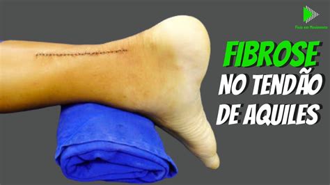 Como acontece a fibrose no tendão de Aquiles após a cirurgia FISIO