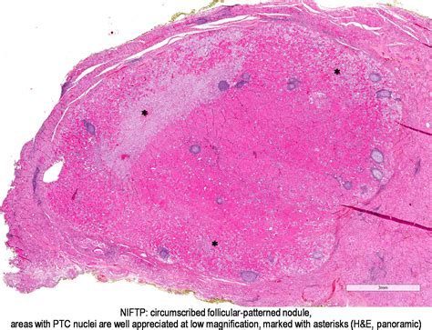 Pathology Outlines Noninvasive Follicular Thyroid Neoplasm With