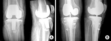 A Initial Radiographs Show A Type Ivb Periprosthetic Tibial Fracture