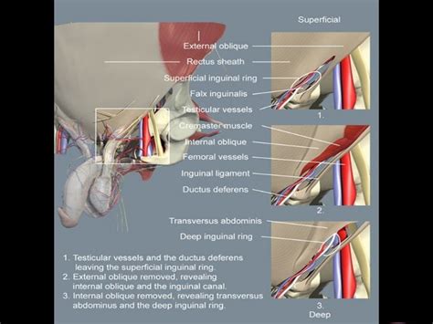 Inguinal Groin Hernia