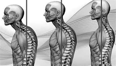 Síntomas Causas Y Tratamientos De La Cifosis Columna Vertebral