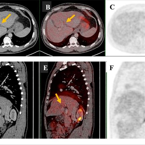 A 47 Year Old Male Patient With Liver Cirrhosis And Subtotal Benign